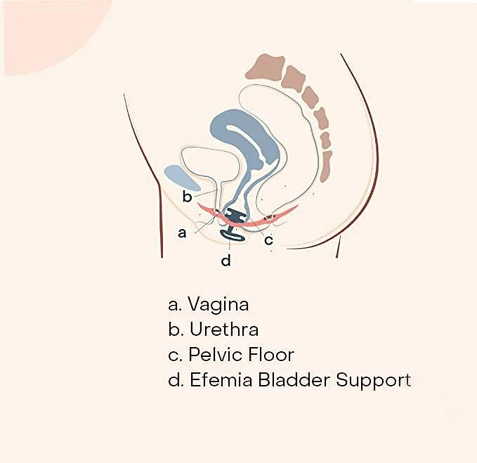 Femsafe Bladder Support Device for Women with Stress Urinary Incontinence 3